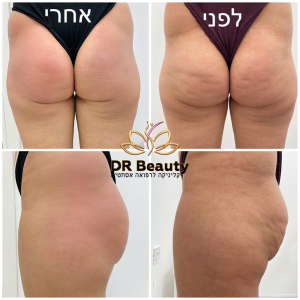 Подтяжка ягодиц с помощью VelaShape
