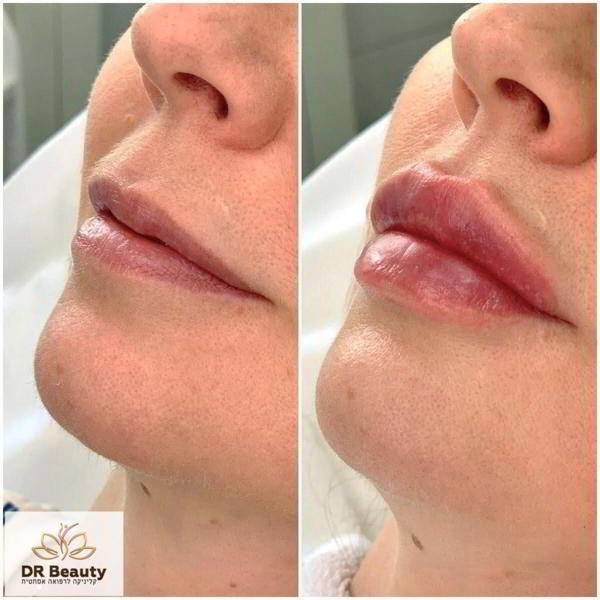Почему уколы красоты нужно делать в Dr Beauty?