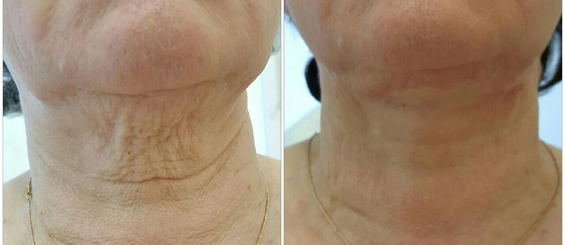Уход за шеей в клинике Dr Beauty