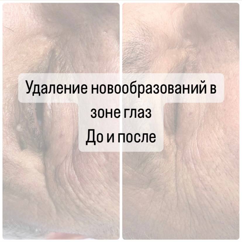 Удаление папиллом на глазах с помощью лазера CO2