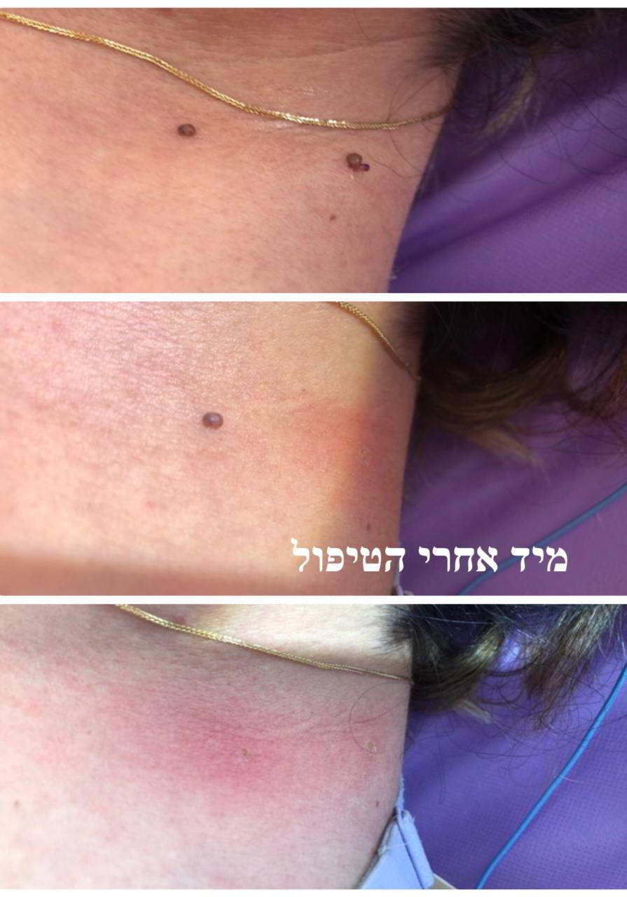 תוצאות לפני ואחרי